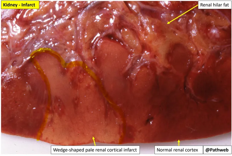 Renal Infarct: Pale, Wedge-Shaped Necrosis
