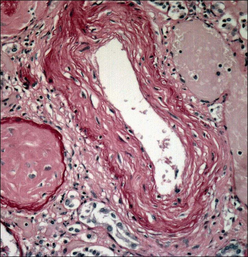Renal Hyaline Arteriolosclerosis Micrograph