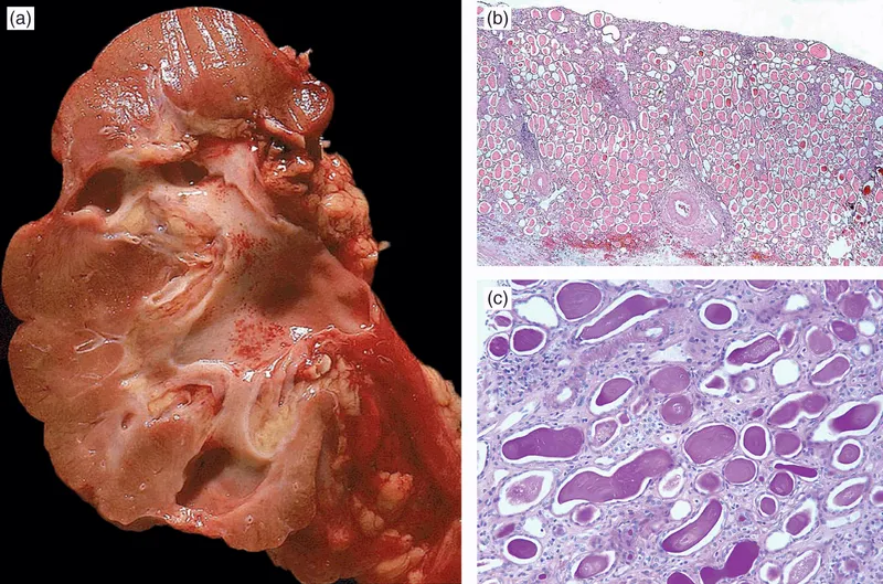 Chronic tubulointerstitial nephritis: gross and microscopic