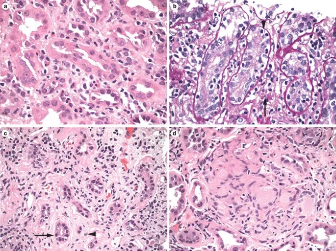 Histology of acute interstitial nephritis