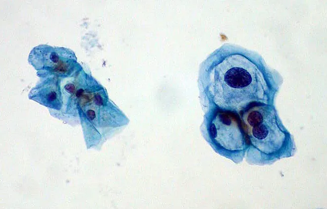 Koilocytes in cervical smear