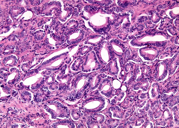 Benign Prostatic Hyperplasia histology