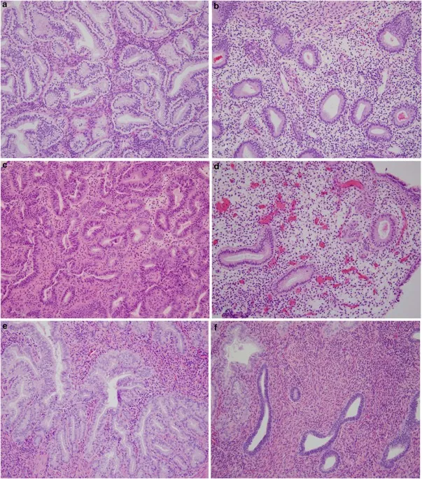 Endometrial Hyperplasia Histology