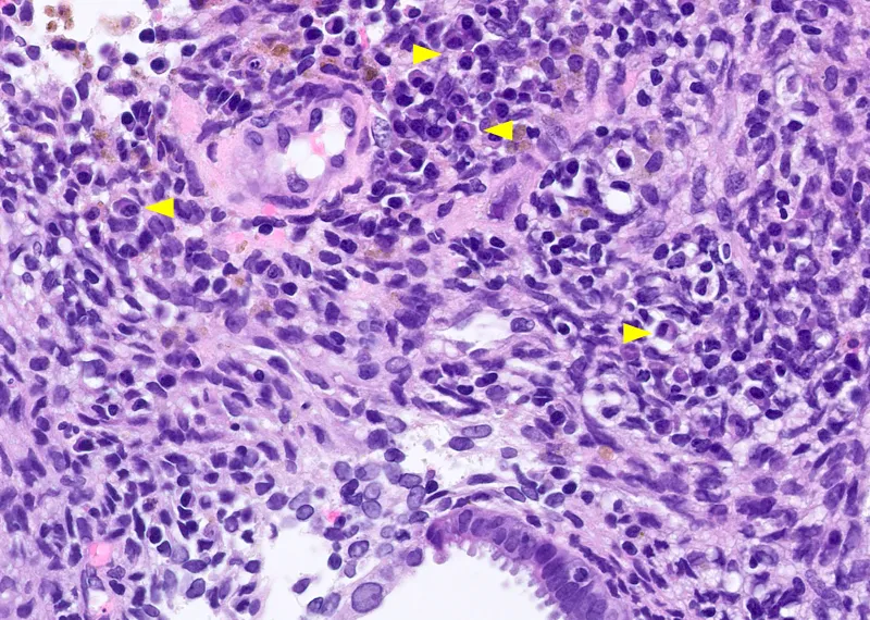 Chronic endometritis histopathology with plasma cells