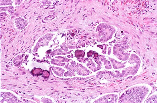 Serous cystadenocarcinoma of ovary with psammoma bodies