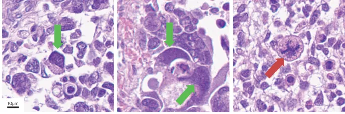 Ovarian Germ Cell Tumor Histology