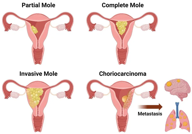 Partial, Complete, Invasive Moles, and Choriocarcinoma