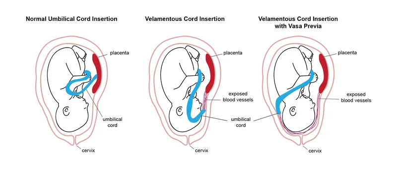 Velamentous Cord Insertion and Vasa Previa