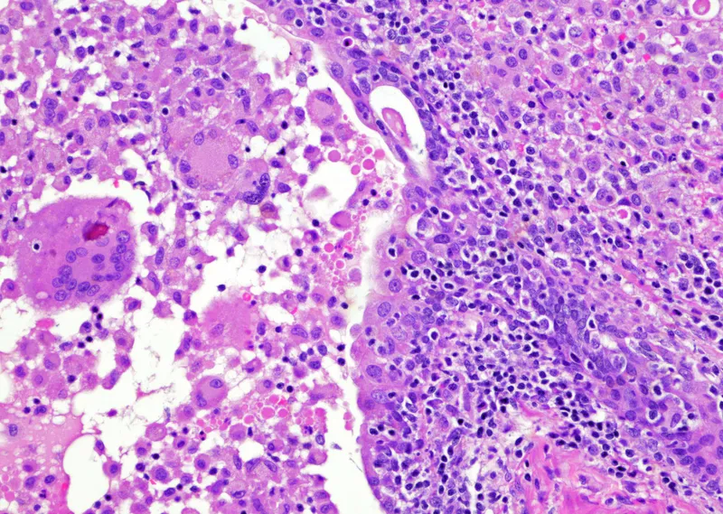 Granulomatous prostatitis with giant cells