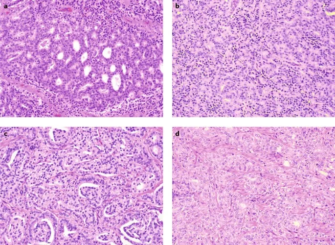 Prostate adenocarcinoma Gleason patterns
