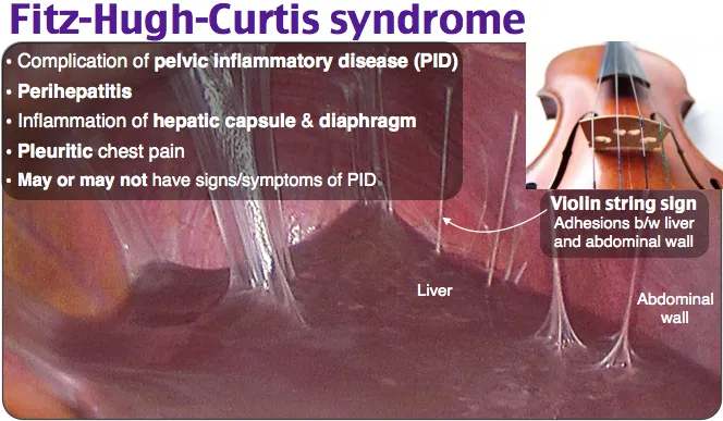 Fitz-Hugh-Curtis syndrome adhesions (violin string sign)