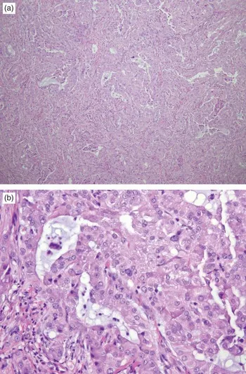 Leydig cell tumor with Reinke crystals