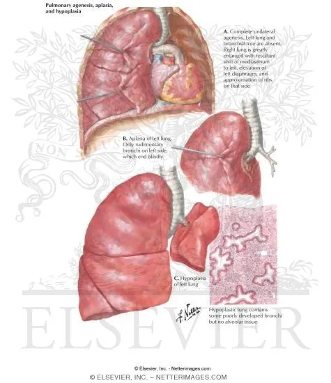 Pulmonary Agenesis, Aplasia, Hypoplasia