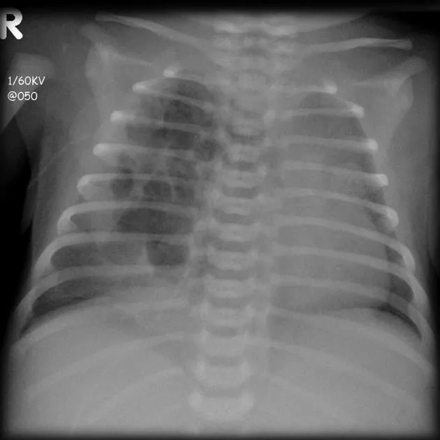 Chest X-ray of Congenital Pulmonary Airway Malformation