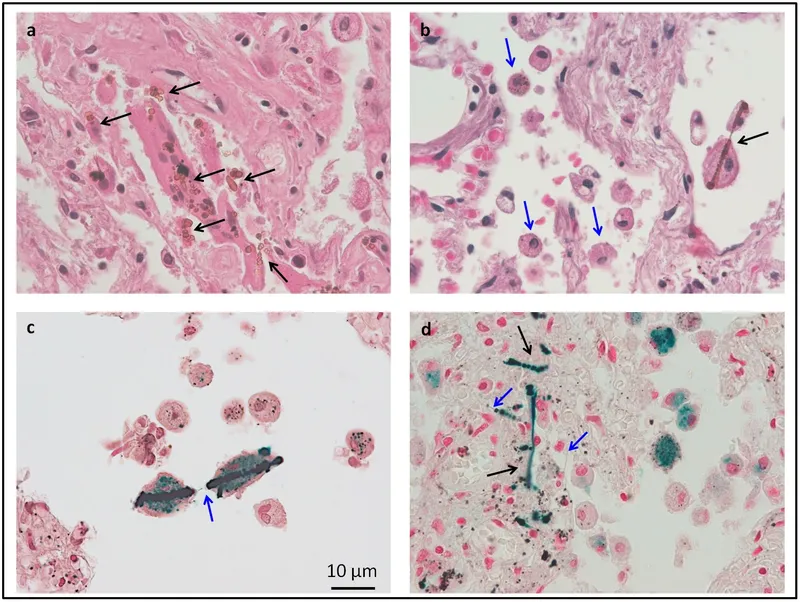 Microscopic views of asbestos bodies in lung tissue