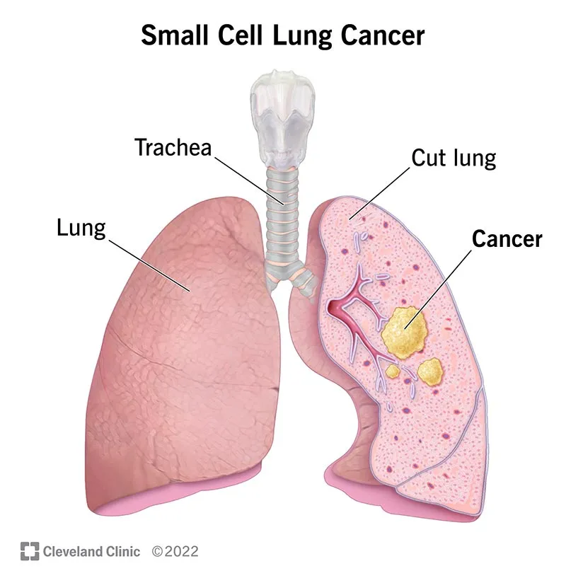 Small Cell Lung Cancer in Lung