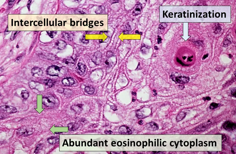 Squamous cell carcinoma histology features