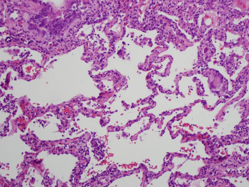 Histology of Hypersensitivity Pneumonitis