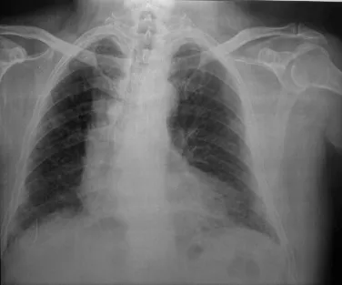 Caplan syndrome CXR