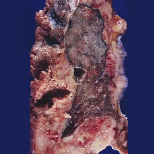 Gross malignant mesothelioma encasing lung