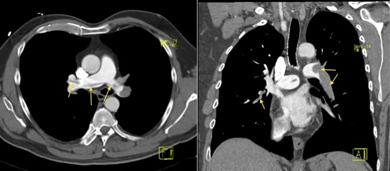 CTPA showing saddle pulmonary embolus