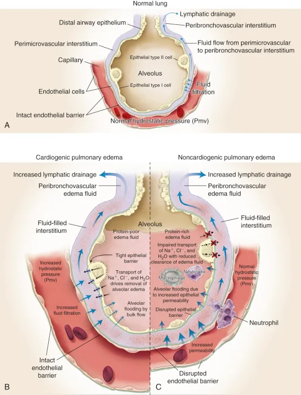 Pulmonary Edema Pathogenesis