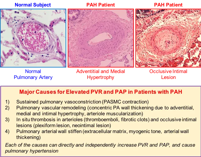 Histology of plexiform lesion in pulmonary hypertension