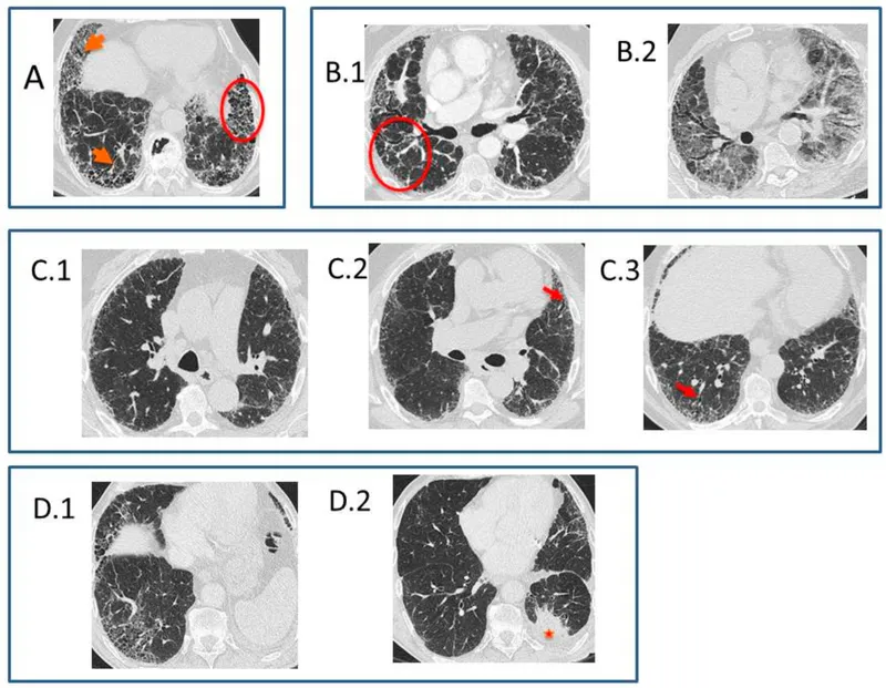 HRCT chest showing typical UIP pattern in IPF