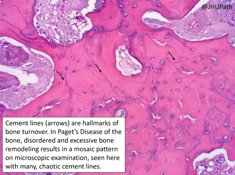 Paget disease of bone: Mosaic pattern of cement lines