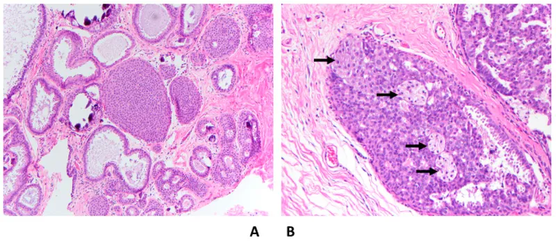 ADH vs UDH Histology