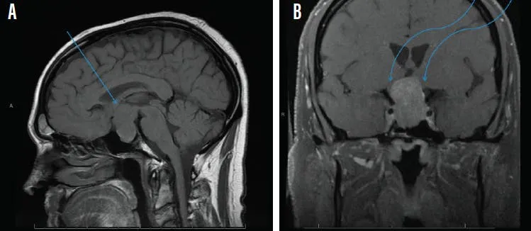 Pituitary adenoma compressing optic chiasm (MRI)