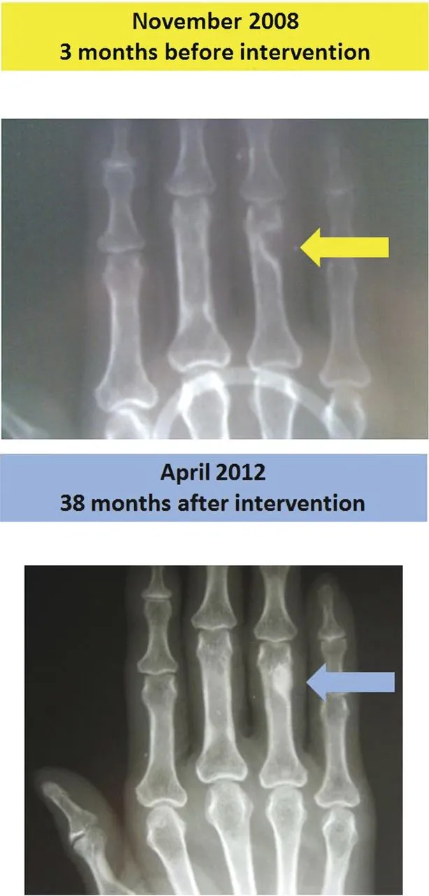 Hand X-rays: Hyperparathyroidism bone changes pre/post-Rx