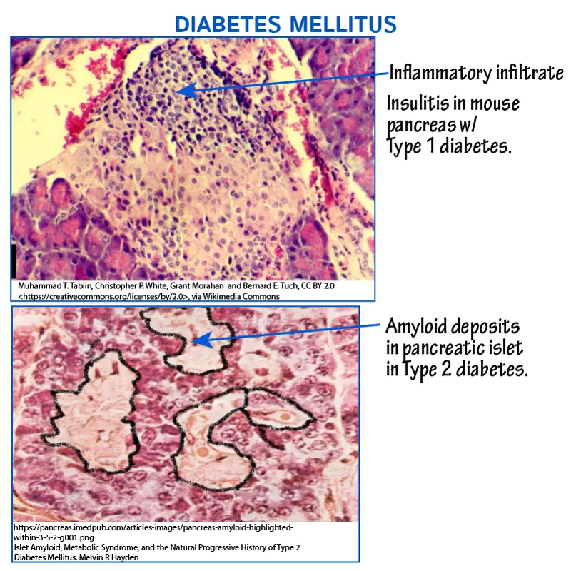 Insulitis in Type 1 vs Amyloid in Type 2 Diabetes