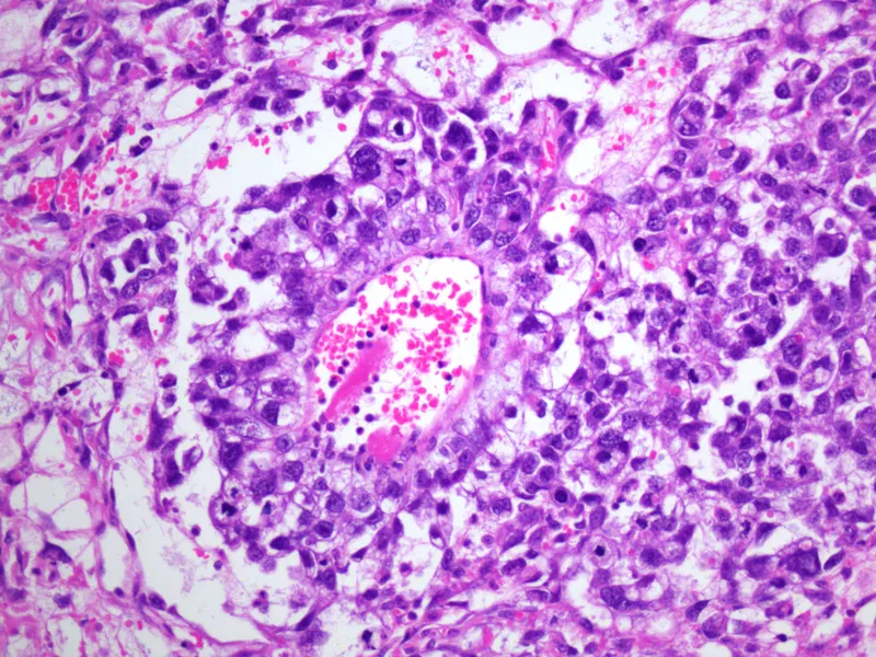 Schiller-Duval body in ovarian yolk sac tumor