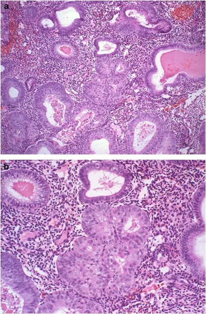 Endometrial Adenocarcinoma Histopathology