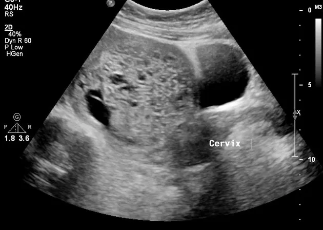 Ultrasound: Complete hydatidiform mole, snowstorm appearance