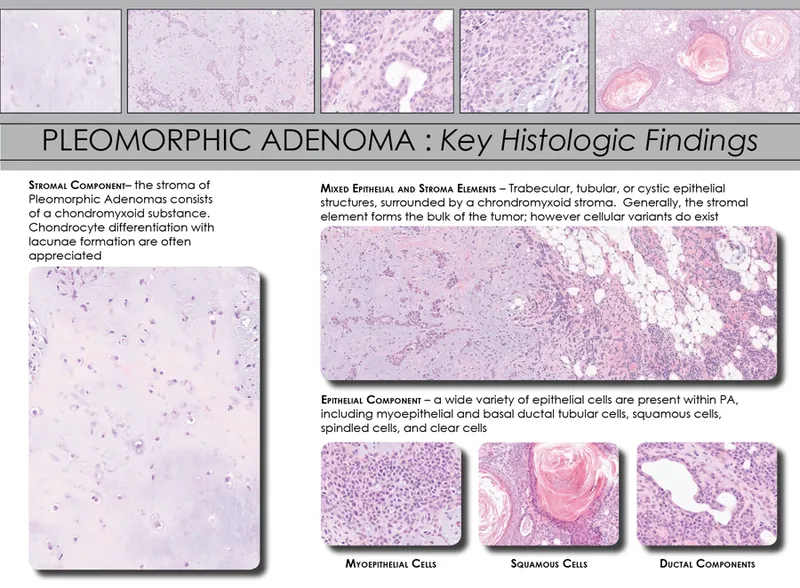 Pleomorphic Adenoma: Histologic Findings