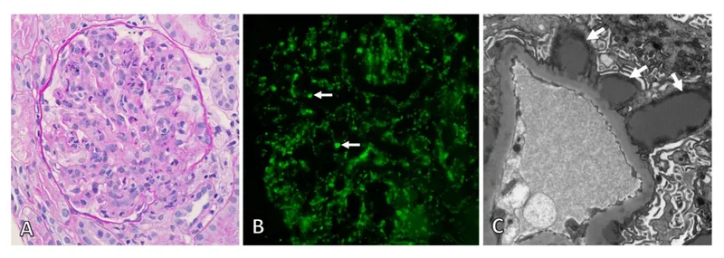 Post-streptococcal glomerulonephritis: Light, IF, EM