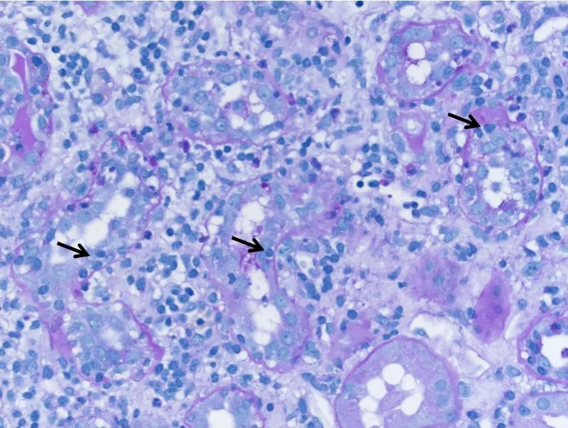 Acute interstitial nephritis with eosinophilic infiltrates