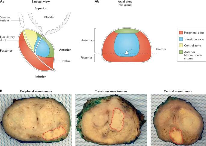 Prostate zones and tumor locations