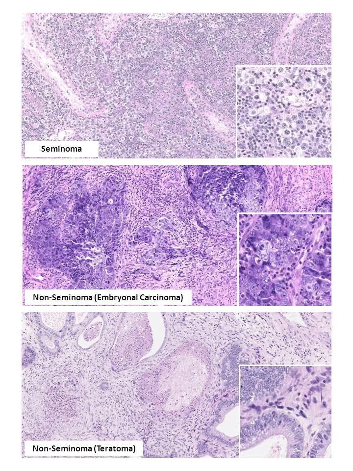 Seminoma vs. Non-Seminoma Histology