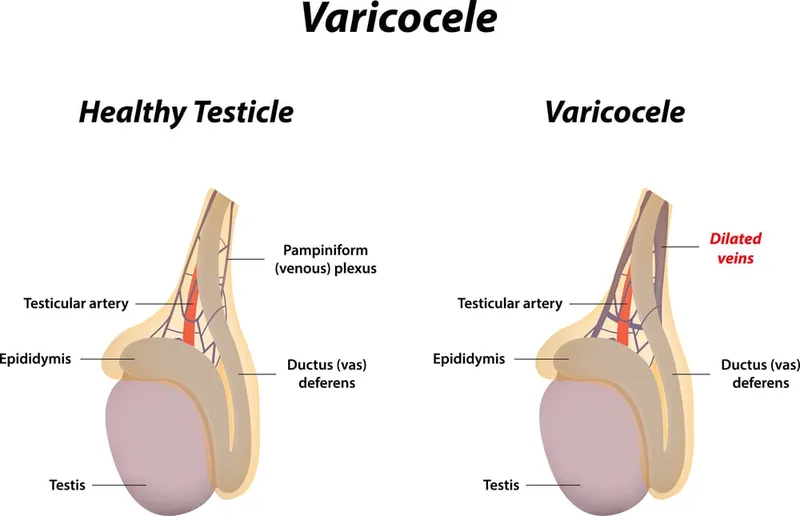 Varicocele: Healthy vs. Affected Testicle Anatomy