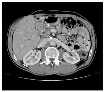 CT: Pancreatic head mass, biliary dilation (arrow)