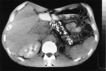 CT: Chronic Pancreatitis with Calcifications & Duct Dilation