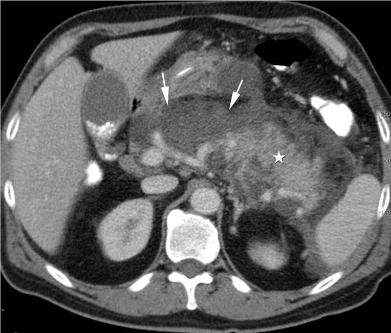 CT: Acute Pancreatitis with Peripancreatic Fat Stranding
