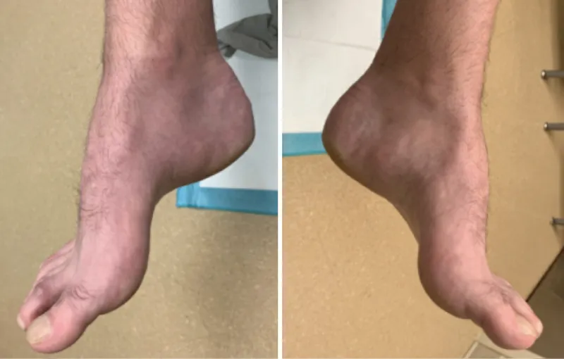 Pes cavus and distal muscle atrophy in Charcot-Marie-Tooth
