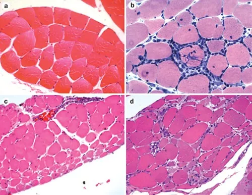 Toxic Myopathy Histopathology: Necrosis and Regeneration