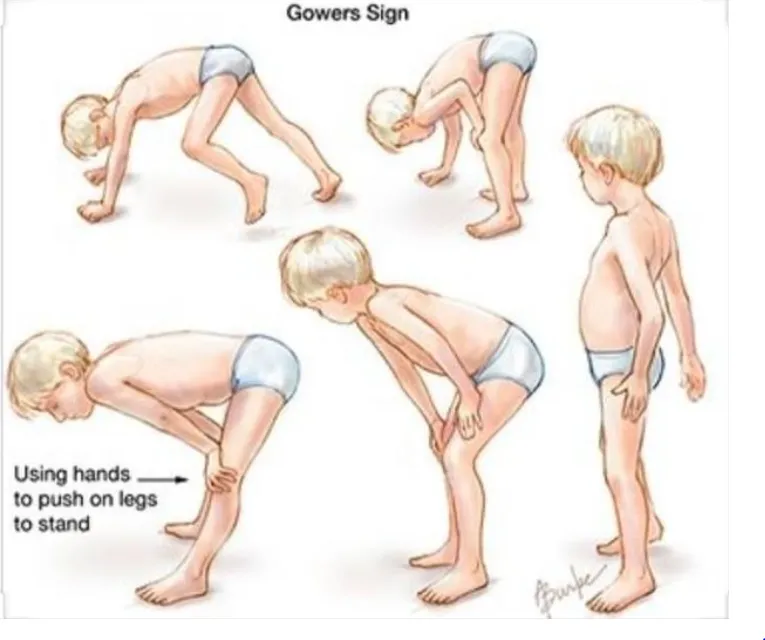 Gowers' sign in Duchenne muscular dystrophy