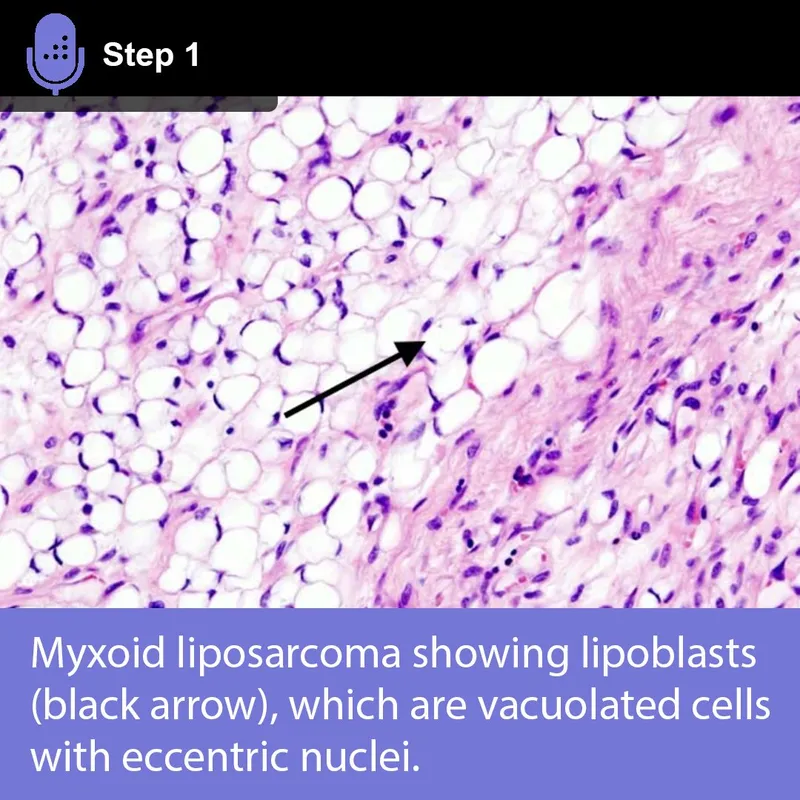 Myxoid liposarcoma with lipoblasts (H&E)