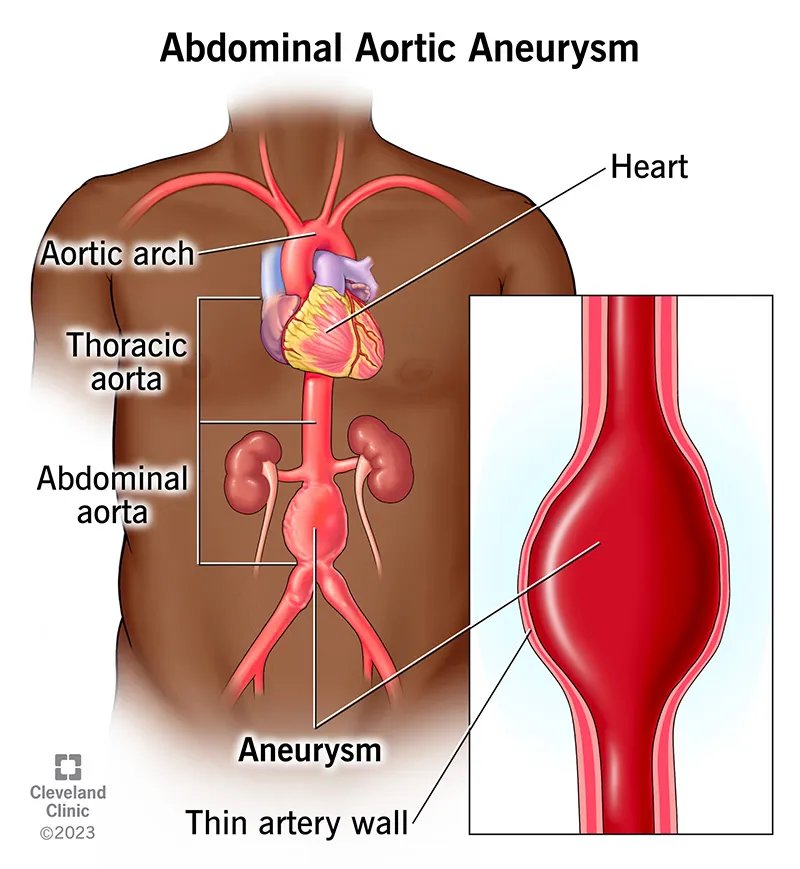Abdominal Aortic Aneurysm Illustration